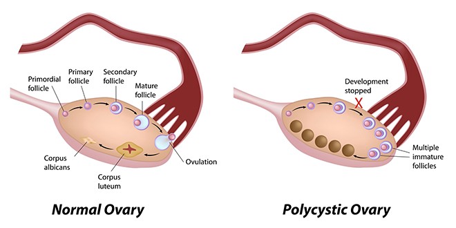 New Discovery of the Cause of Polycystic Ovarian Syndrome